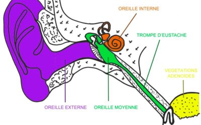 L’otite chronique de l’enfant