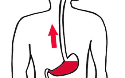 Suspicion de reflux gastro-oesophagien : conduite à tenir